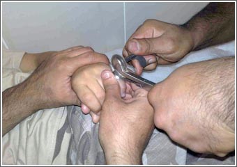 أطباء «العدان» يستعينون بإطفاء المنقف لإجراء عملية جراحية لطفل حشر إصبعه في حلقة حديدية