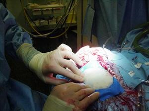 يد الجراح اثناء العملية الدقيقة
﻿