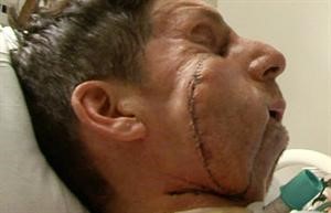 جراح فرنسي يُجري أول عملية لزرع وجه كامل على الإطلاق 