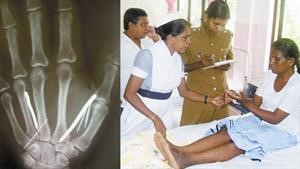 الخادمة السريلانكية في المستشفى وفي الصورة الثانيةالاشعة السينية توضح عددا من المسامير والابر في يدها اليسرى﻿