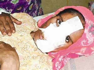 الباكستانية في المستشفى بعد قطع انفها وحلاقة شعرها﻿