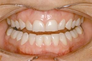 د.عصام الحزامي لـ «الأنباء»: سن الزركونيوم المغلفة بالسيراميك هي الأقرب إلى الأسنان الطبيعية