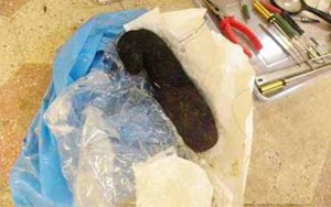 الجسم السحري الذي تم اخراجه من بطن المريض المسحور