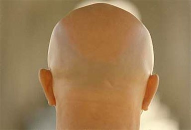 علماء يكتشفون مصدر تنشيط  نمو الشعر بهدف معالجة الصلع