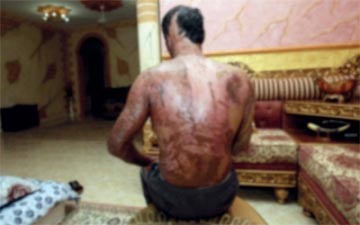 سلامة بنت حمدان آل نهيان تتكفل بعلاج «جاسم» الذي رماه آسيوي بماء النار