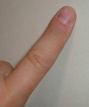 27 ألف إسترليني تعويضاً عن.. فقدان أصبع