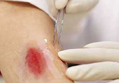 شريحة إلكترونية لعلاج الجروح والآلام