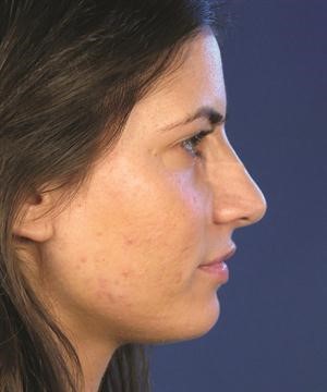 تجرى عمليات تجميل الانف جراحيا وطبيا﻿
