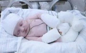 وفاة طفل بعد 3 أعوام من ولادته بدون مخ