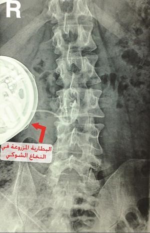 البطارية المزروعة في النخاع الشوكي