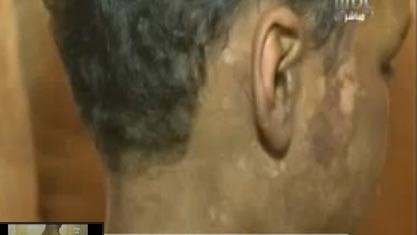 بالفيديو.. عذبه والديه بالحرق بالماء المغلي وقلع الاظافر  لأنه نتيجة علاقة الوالدين غير الشرعية قبل الزواج