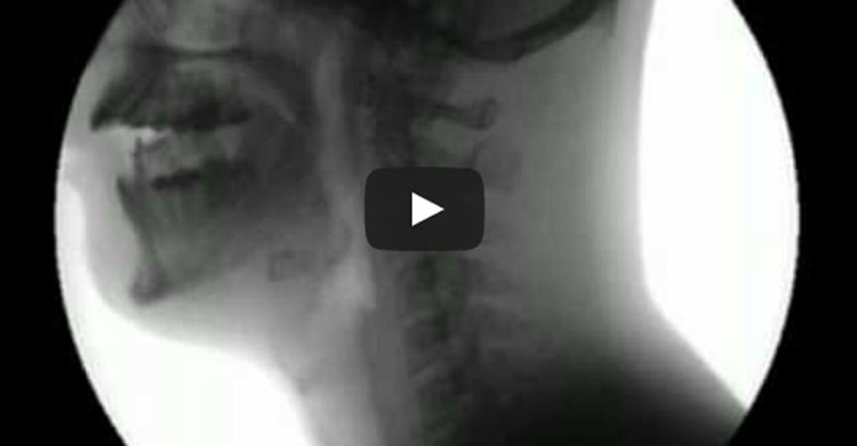 فيديو مذهل يصور الانسان أثناء أكله  من خلال أشعه X-Ray