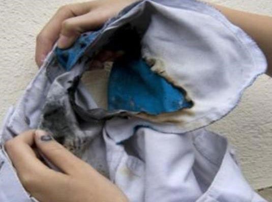 بالصور.. انفجار " جالاكسي إس 3 " في جيب فتاة يتسبب في حروق عميقة بجسدها