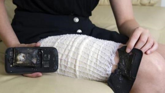 بالصور.. انفجار " جالاكسي إس 3 " في جيب فتاة يتسبب في حروق عميقة بجسدها