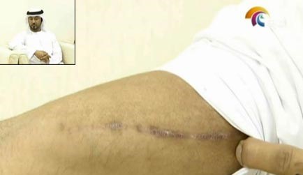 بالفيديو.. مأساة إماراتي حقن نفسه بالسيلكون للحصول على جسد مثالي