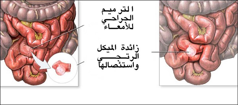 المسح الإشعاعي للميكل الرتجي (Meckel