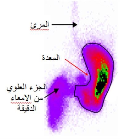 المسح الإشعاعي لقياس تفريغ المعدة