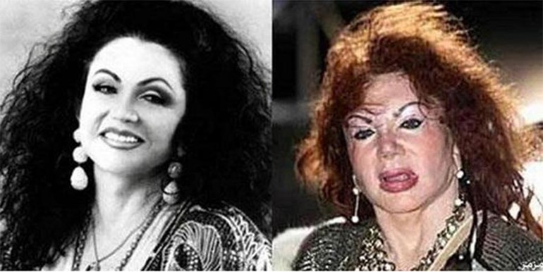 بالصور.. عمليات التجميل حين تشوّه السيدات وتحوّل وجوههن لكارثة!