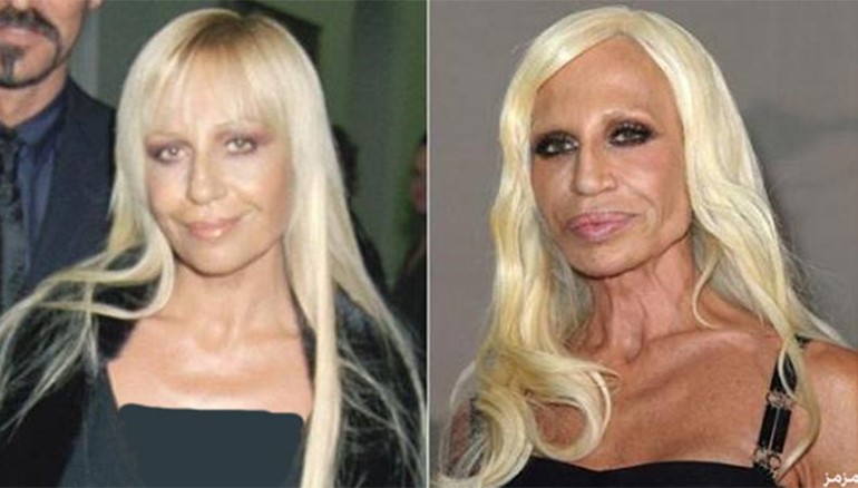 بالصور.. عمليات التجميل حين تشوّه السيدات وتحوّل وجوههن لكارثة!