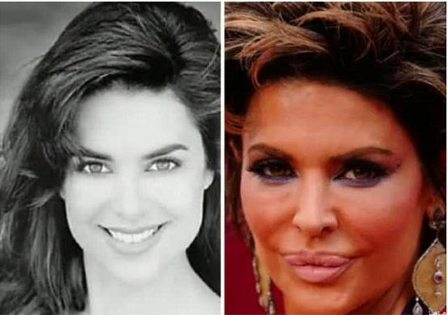 بالصور.. عمليات التجميل حين تشوّه السيدات وتحوّل وجوههن لكارثة!