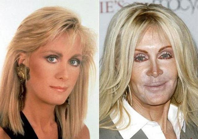 بالصور.. عمليات التجميل حين تشوّه السيدات وتحوّل وجوههن لكارثة!