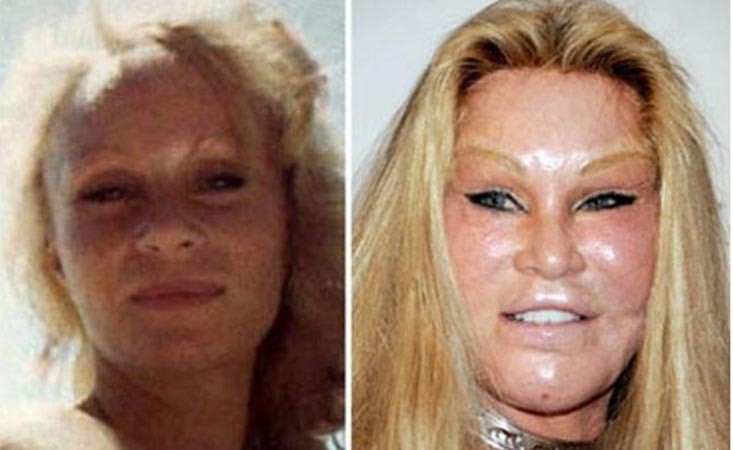 بالصور.. عمليات التجميل حين تشوّه السيدات وتحوّل وجوههن لكارثة!