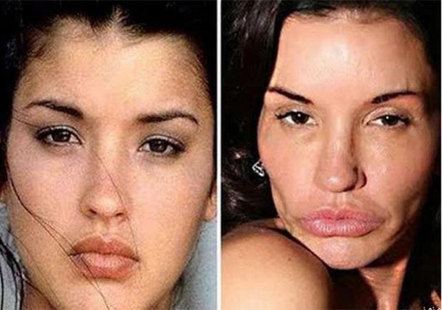 بالصور.. عمليات التجميل حين تشوّه السيدات وتحوّل وجوههن لكارثة!