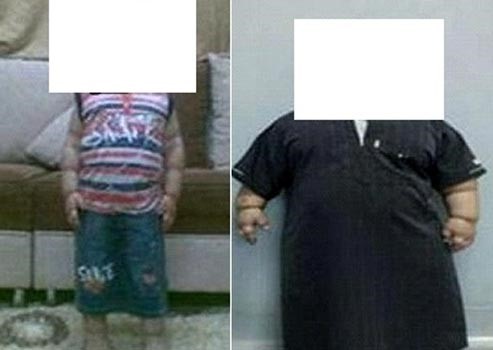 صورة: طفل سعودي.. أصغر شخص في العالم يخضع لعملية تصغير للمعدة