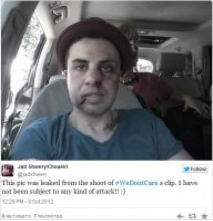 صورة: جاد شويري يكشف حقيقة «كدمات» وجهه