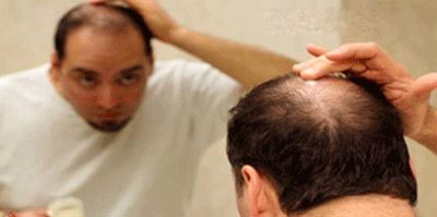 علماء أميركيون ينجحون في ابتكار علاج نهائي للصلع
