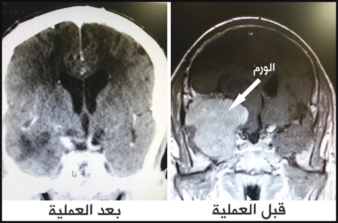 فريق جراحي المخ والأعصاب بمستشفى دار الشفاء يستأصل ورماً بالمخ يزن 240 غراماً