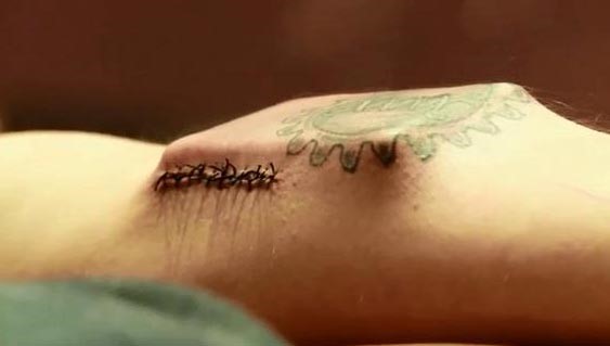 أميركي يبتكر شريحة تحت الجلد تنقل البيانات من جسم صاحبها إلى أجهزة أندرويد