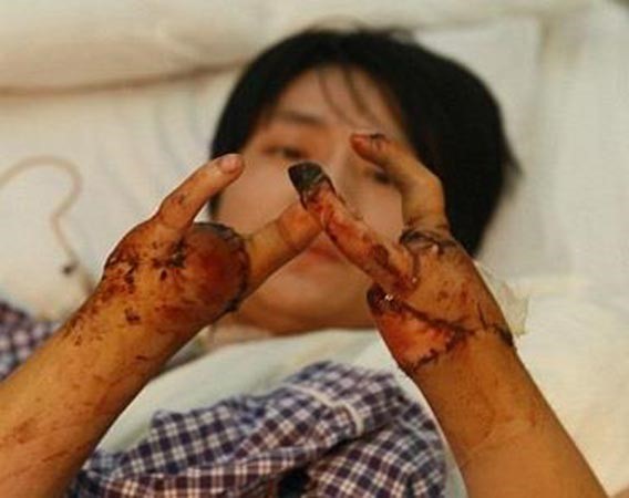 بالصور.. إصابة عمل تُفقد صينياً يده وأصابعه والأطباء يستبدلونها بكماشتيٌن