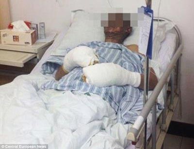 صورة: كهرباء ساكنة في ملابس سبعيني تتسبب له في حروق من الدرجة الثالثة