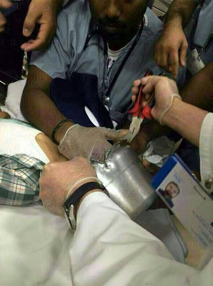 بالصور.. إنقاذ طفل في السعودية علق رأسه في قدر ضغط كان يلعب به