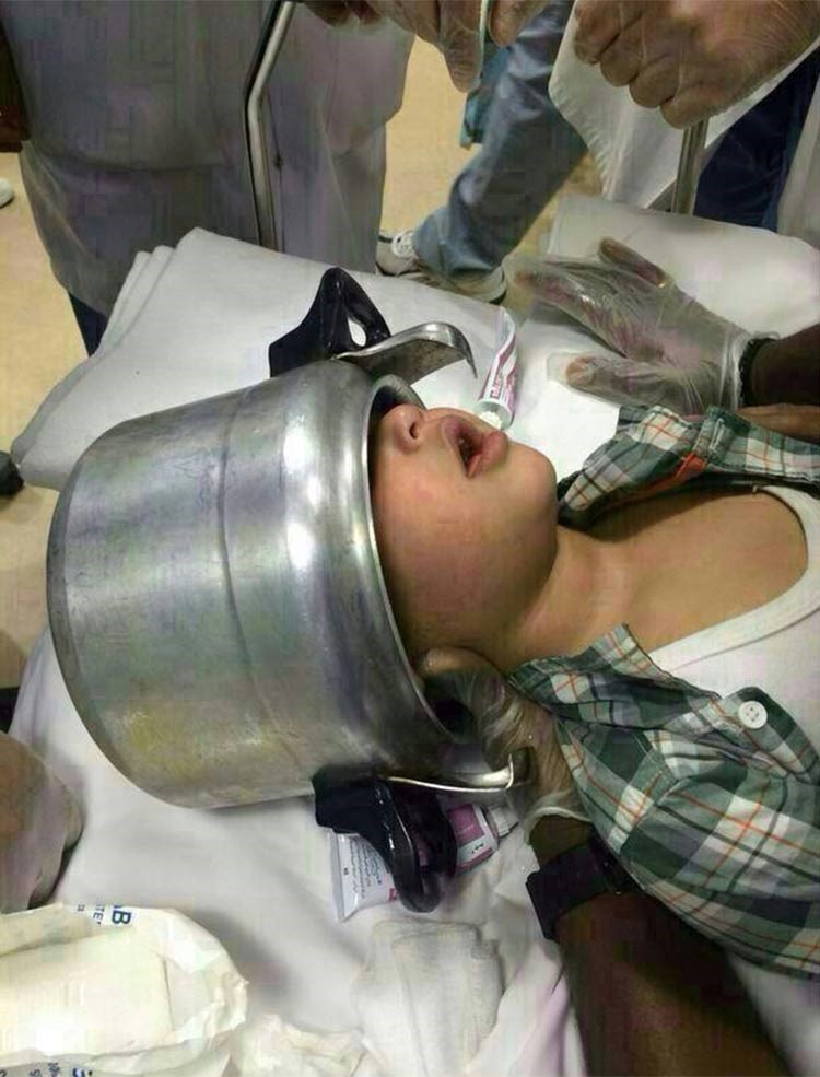 بالصور.. إنقاذ طفل في السعودية علق رأسه في قدر ضغط كان يلعب به