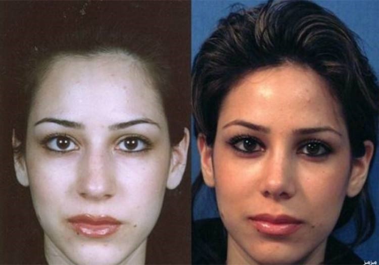 بالصور.. إيران عاصمة عمليات تجميل الأنف في العالم