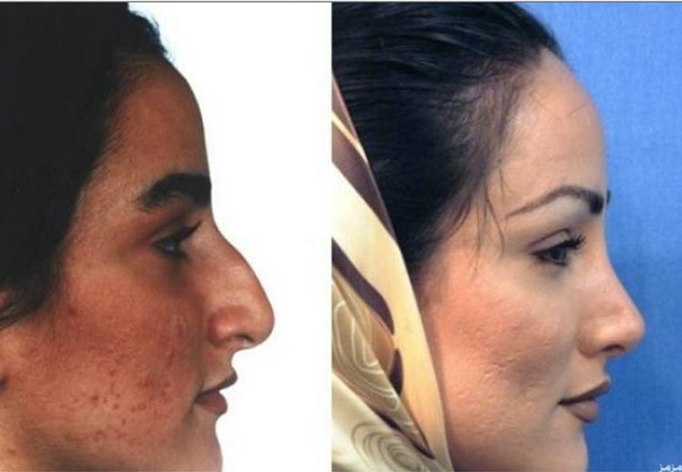 بالصور.. إيران عاصمة عمليات تجميل الأنف في العالم