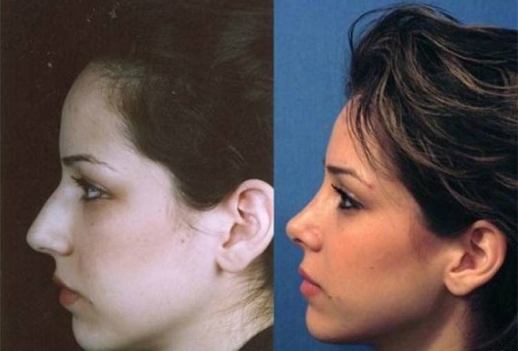 بالصور.. إيران عاصمة عمليات تجميل الأنف في العالم