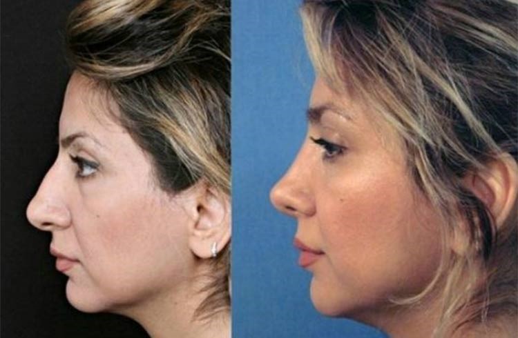 بالصور.. إيران عاصمة عمليات تجميل الأنف في العالم