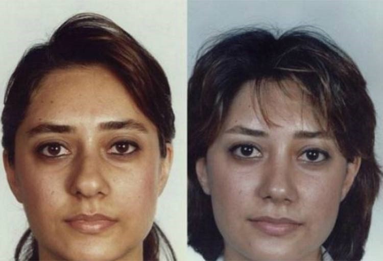 بالصور.. إيران عاصمة عمليات تجميل الأنف في العالم