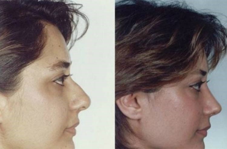 بالصور.. إيران عاصمة عمليات تجميل الأنف في العالم