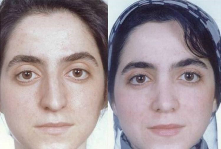 بالصور.. إيران عاصمة عمليات تجميل الأنف في العالم