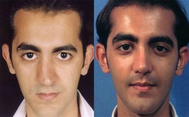 بالصور.. إيران عاصمة عمليات تجميل الأنف في العالم