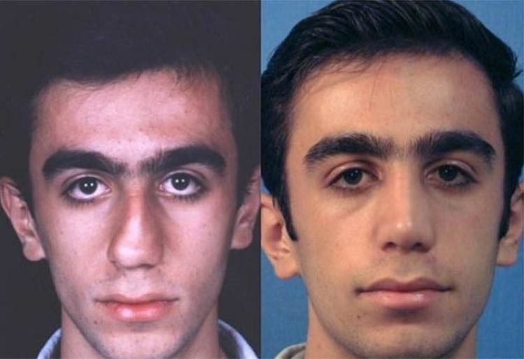 بالصور.. إيران عاصمة عمليات تجميل الأنف في العالم