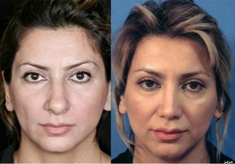 بالصور.. إيران عاصمة عمليات تجميل الأنف في العالم