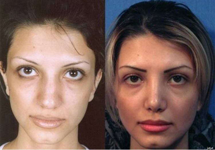 بالصور.. إيران عاصمة عمليات تجميل الأنف في العالم