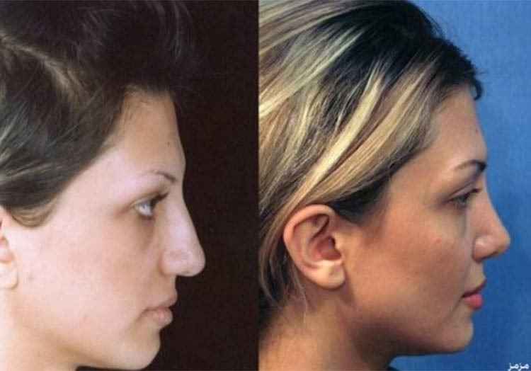 بالصور.. إيران عاصمة عمليات تجميل الأنف في العالم