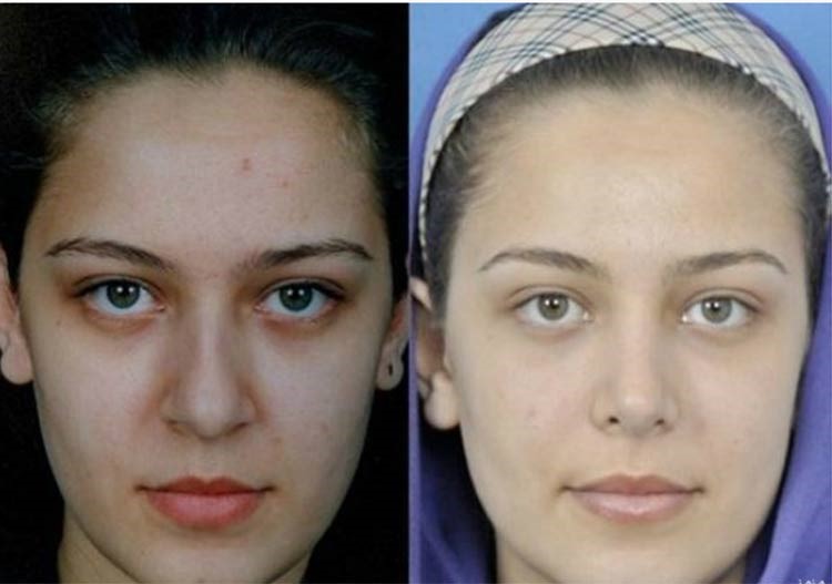 بالصور.. إيران عاصمة عمليات تجميل الأنف في العالم