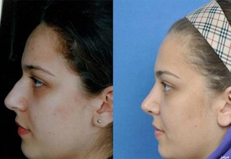 بالصور.. إيران عاصمة عمليات تجميل الأنف في العالم